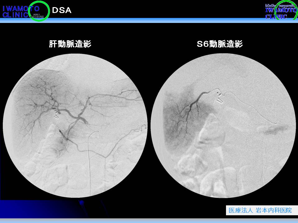 DSA　肝動脈造影とＳ６動脈造影