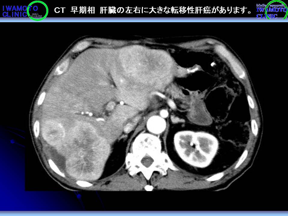ＣＴ　早期相　肝臓の左右に大きな転移性肝癌があります。