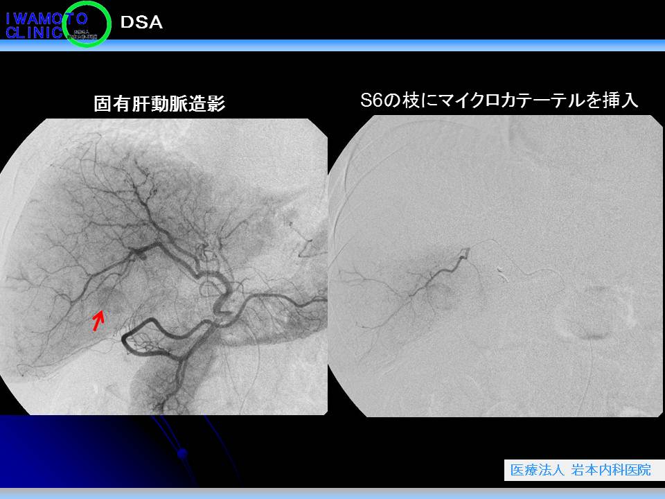 ＤＳＡ　固有肝動脈造影　S6の枝にマイクロカテーテルを挿入