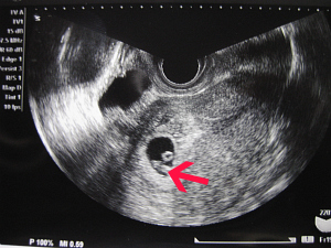 確認 いつ 心拍 胎児心拍はいつ確認できましたか？