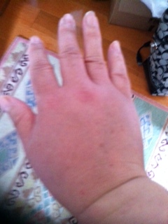 My hand stung by bee